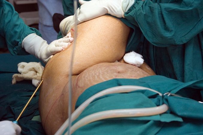 Riebalų nusiurbimas, liposakcija, plastinė chirurgija, plastinė operacija