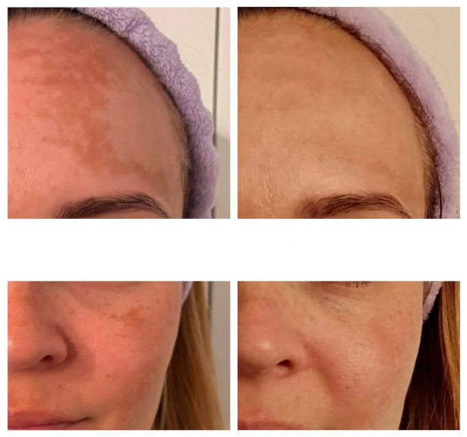 Rezultatai-po-trijų-DKK-PRP-terapijos-seansų